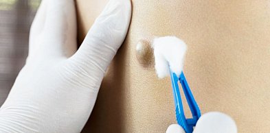 Torbiel włosowa – etapy rozwoju i znaczenie leczenia