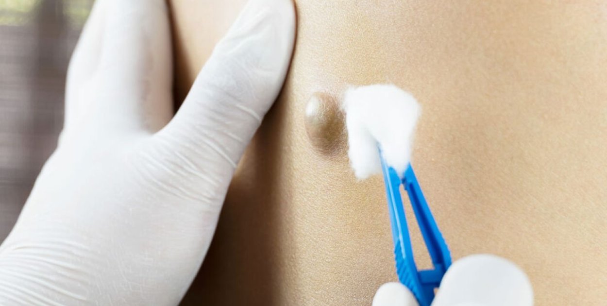 Torbiel włosowa – etapy rozwoju i znaczenie leczenia